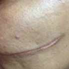 Scar Before Treatment
